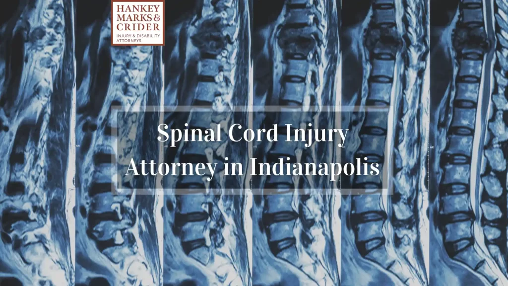 Spinal Cord Injury Attorney in Indianapolis